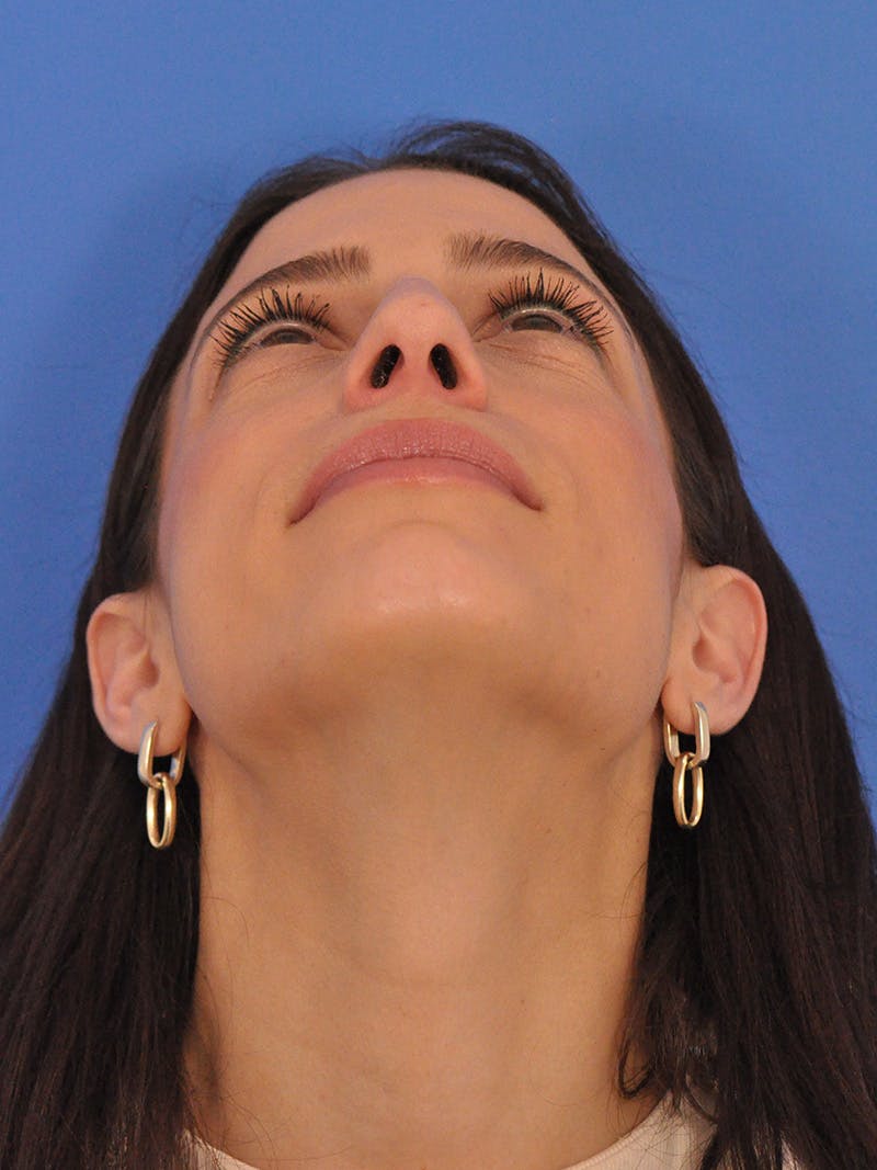 Rhinoplasty Before & After Gallery - Patient 100951 - Image 11