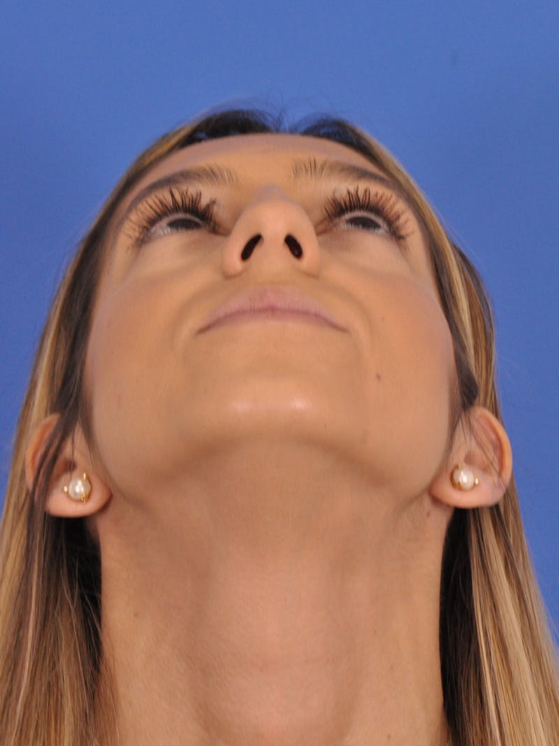 Rhinoplasty Before & After Gallery - Patient 587792 - Image 7