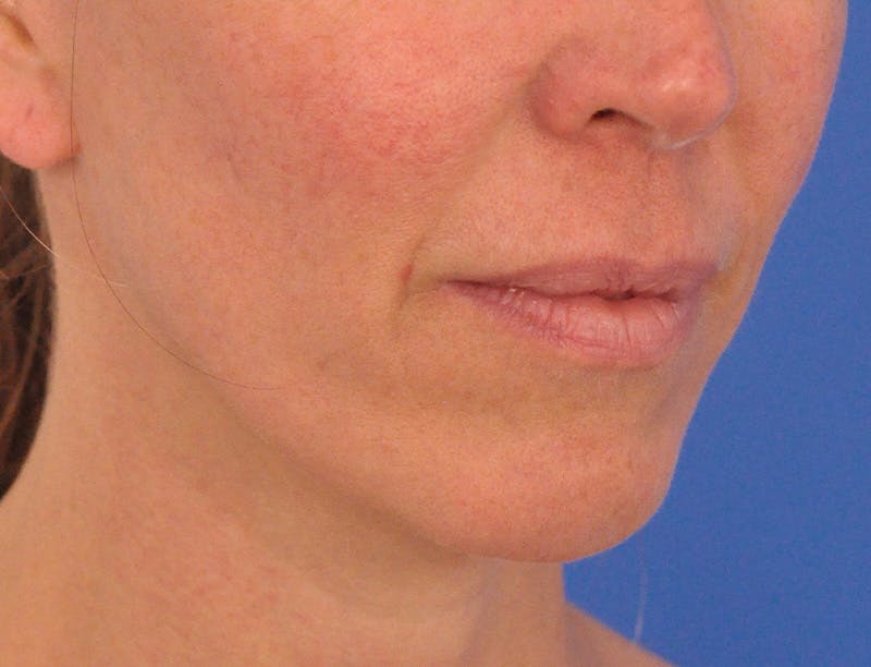 Lip Lift Before & After Gallery - Patient 336999 - Image 5