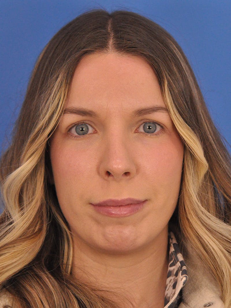 Rhinoplasty Before & After Gallery - Patient 135722 - Image 6