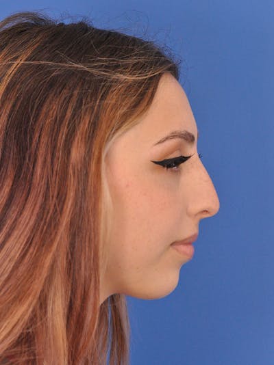 Rhinoplasty Before & After Gallery - Patient 192652 - Image 1