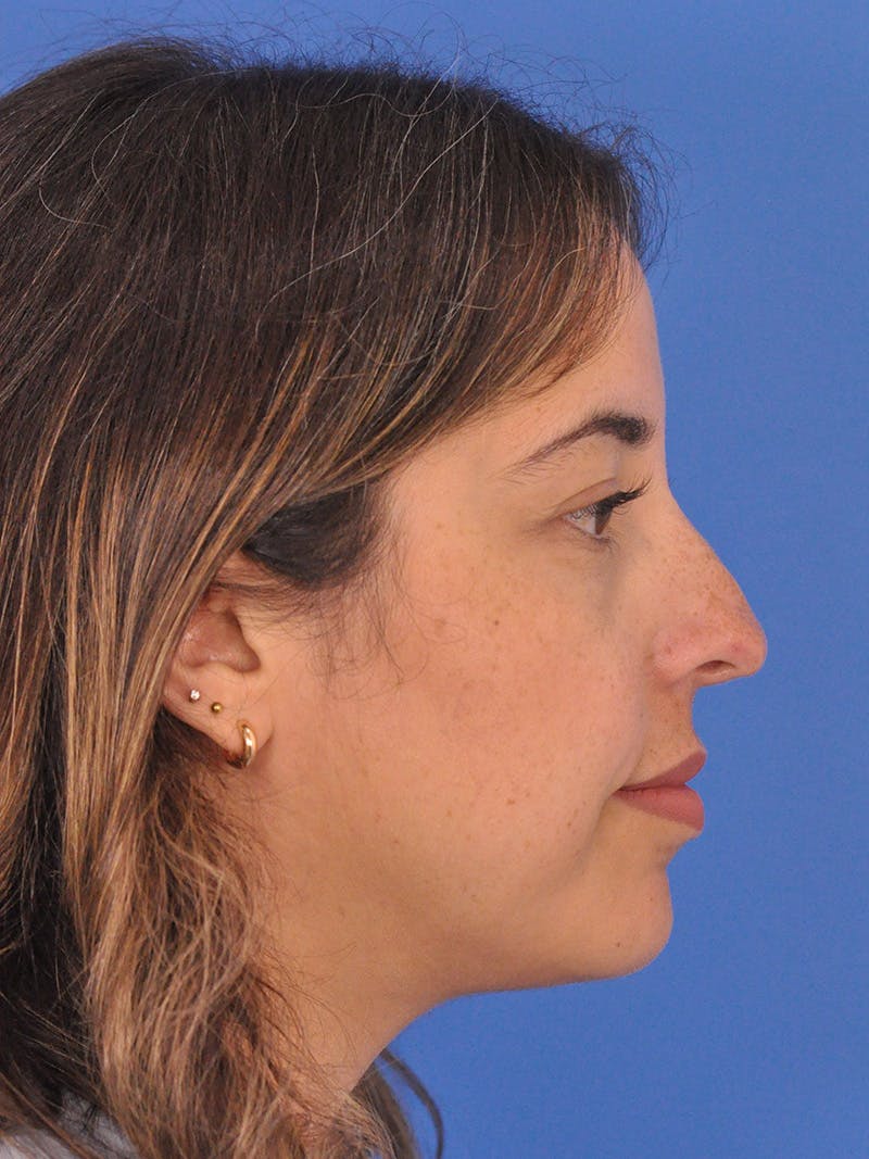 Rhinoplasty Before & After Gallery - Patient 277111 - Image 1
