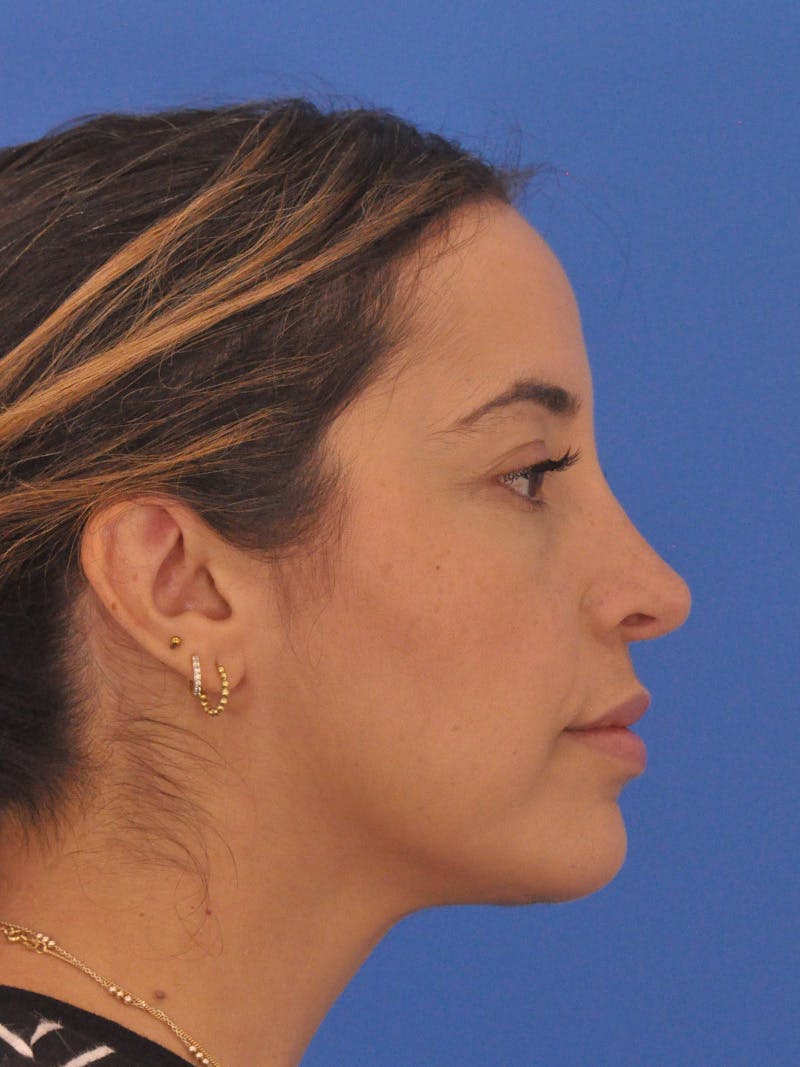 Rhinoplasty Before & After Gallery - Patient 277111 - Image 2