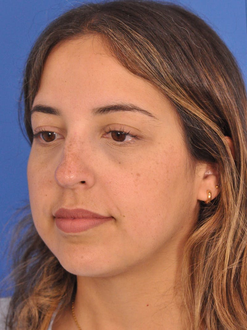 Rhinoplasty Before & After Gallery - Patient 277111 - Image 7