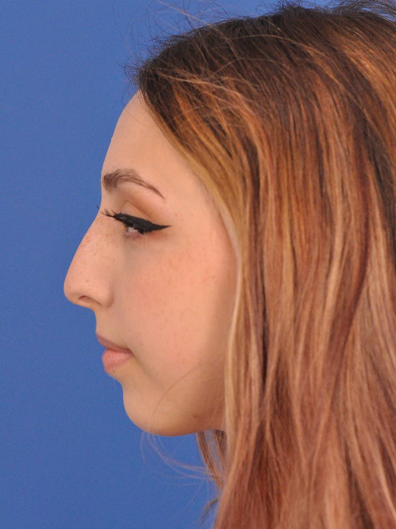 Rhinoplasty Before & After Gallery - Patient 192652 - Image 11