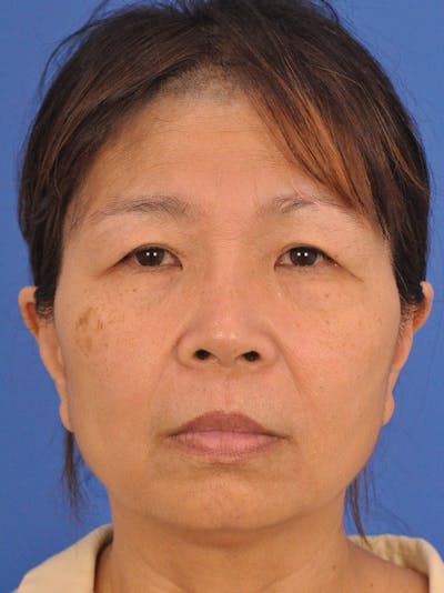 Facelift Before & After Gallery - Patient 227711 - Image 1
