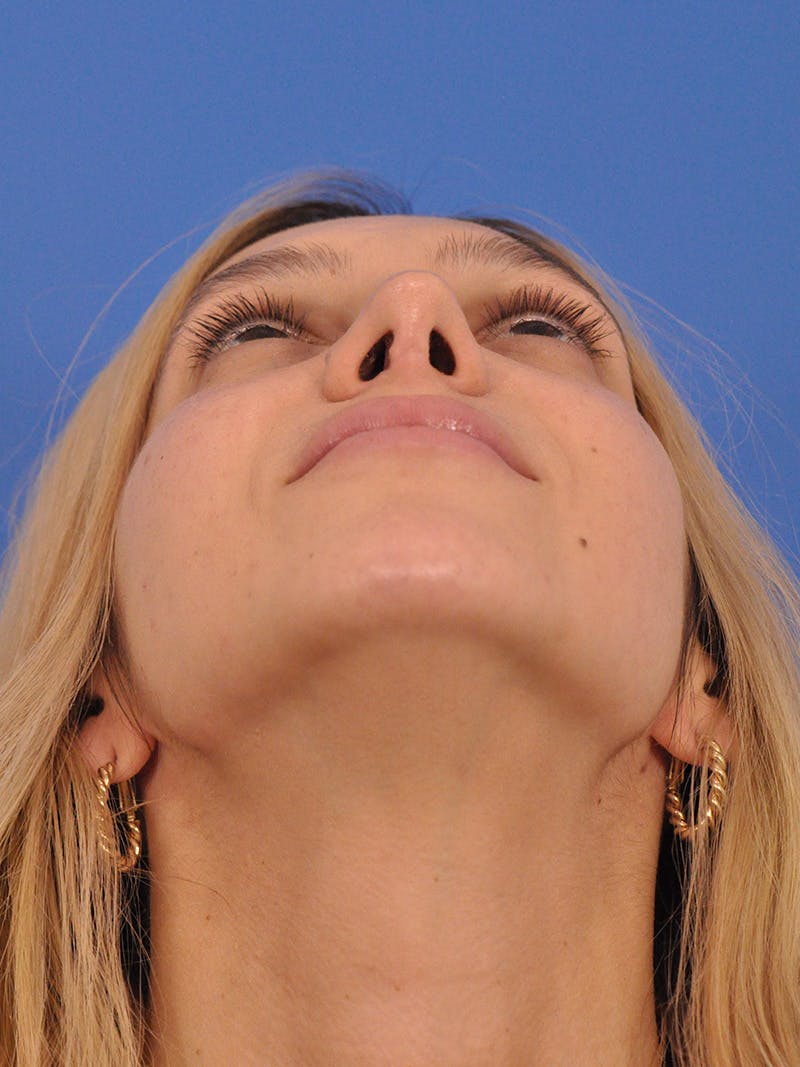 Rhinoplasty Before & After Gallery - Patient 587792 - Image 8