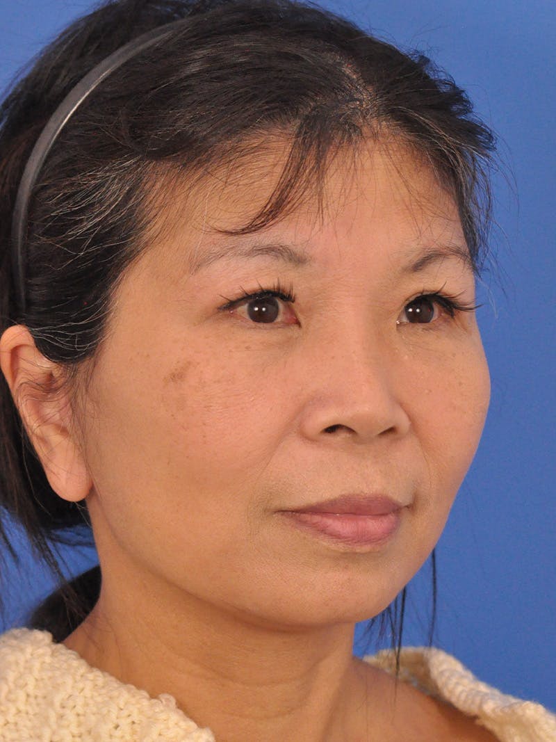 Facelift Before & After Gallery - Patient 227711 - Image 4