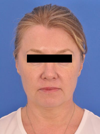 Facelift Before & After Gallery - Patient 202421 - Image 1