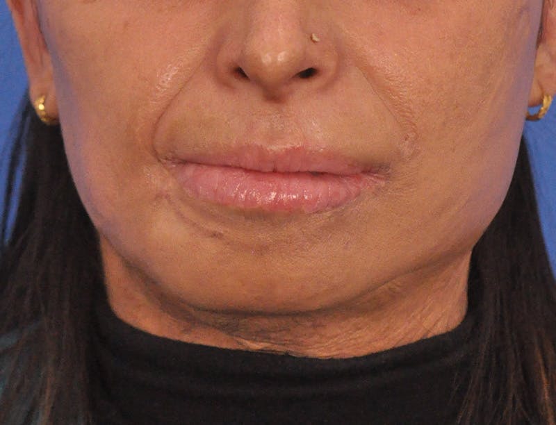 Lip Lift Before & After Gallery - Patient 380904 - Image 2