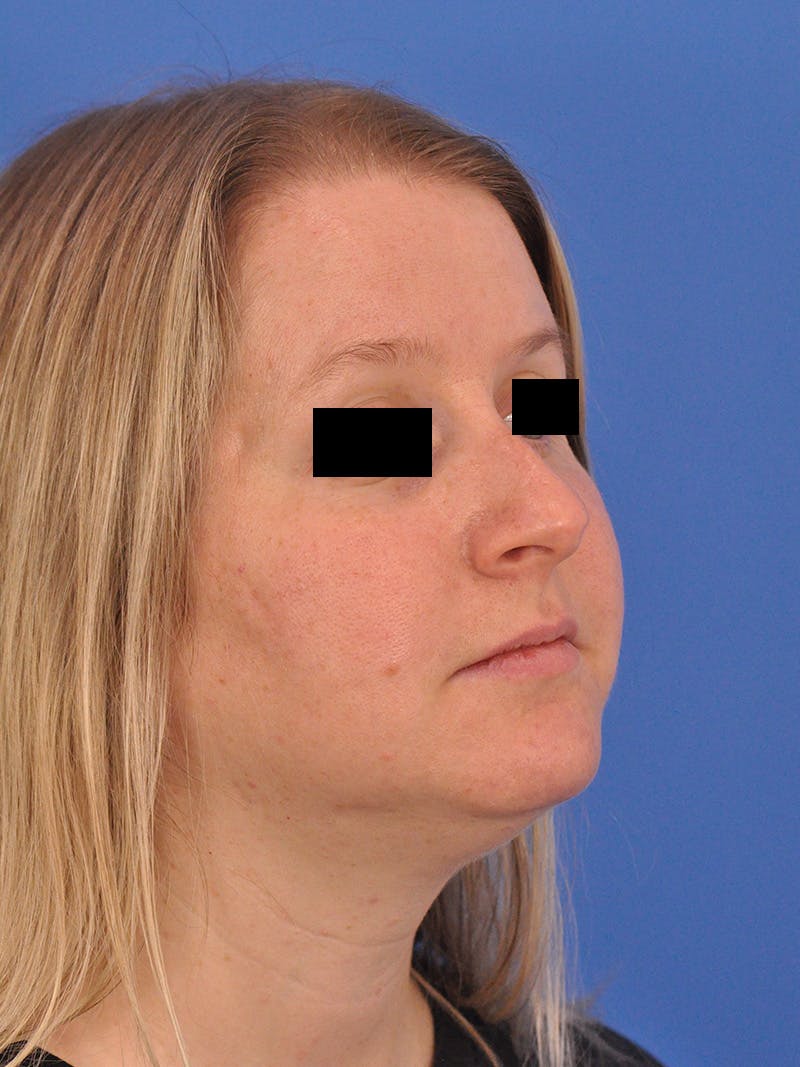 Rhinoplasty Before & After Gallery - Patient 157621 - Image 3