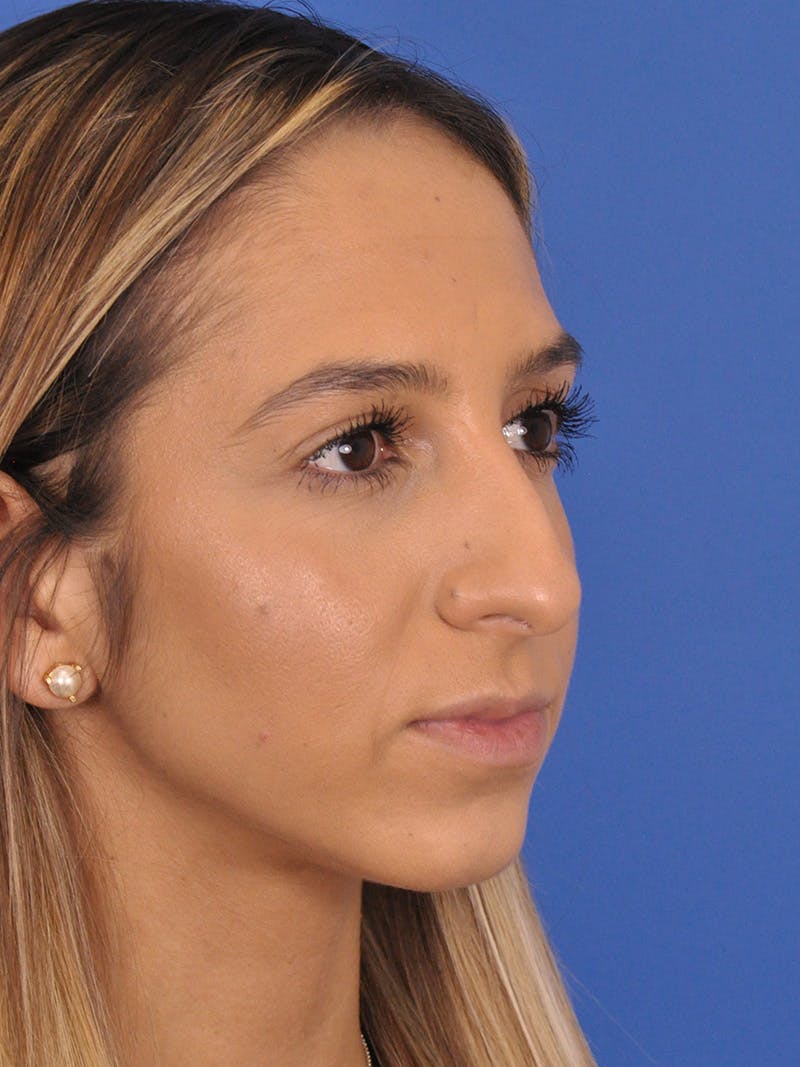 Rhinoplasty Before & After Gallery - Patient 587792 - Image 3