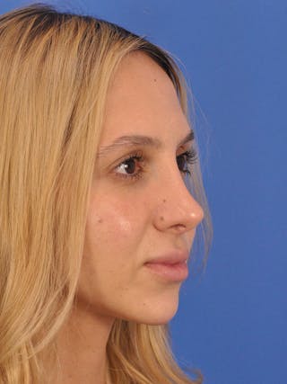 Rhinoplasty Before & After Gallery - Patient 587792 - Image 4