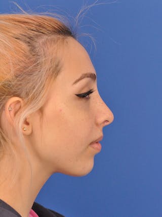 Rhinoplasty Before & After Gallery - Patient 192652 - Image 2