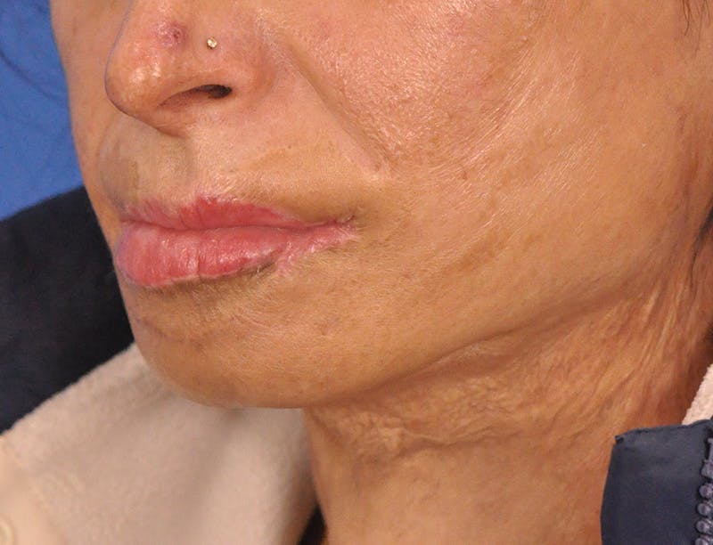 Lip Lift Before & After Gallery - Patient 380904 - Image 5