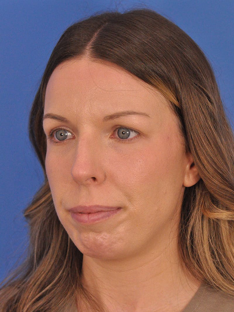 Rhinoplasty Before & After Gallery - Patient 135722 - Image 7