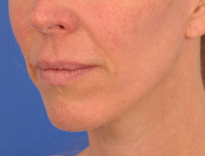 Lip Lift Before & After Gallery - Patient 336999 - Image 9