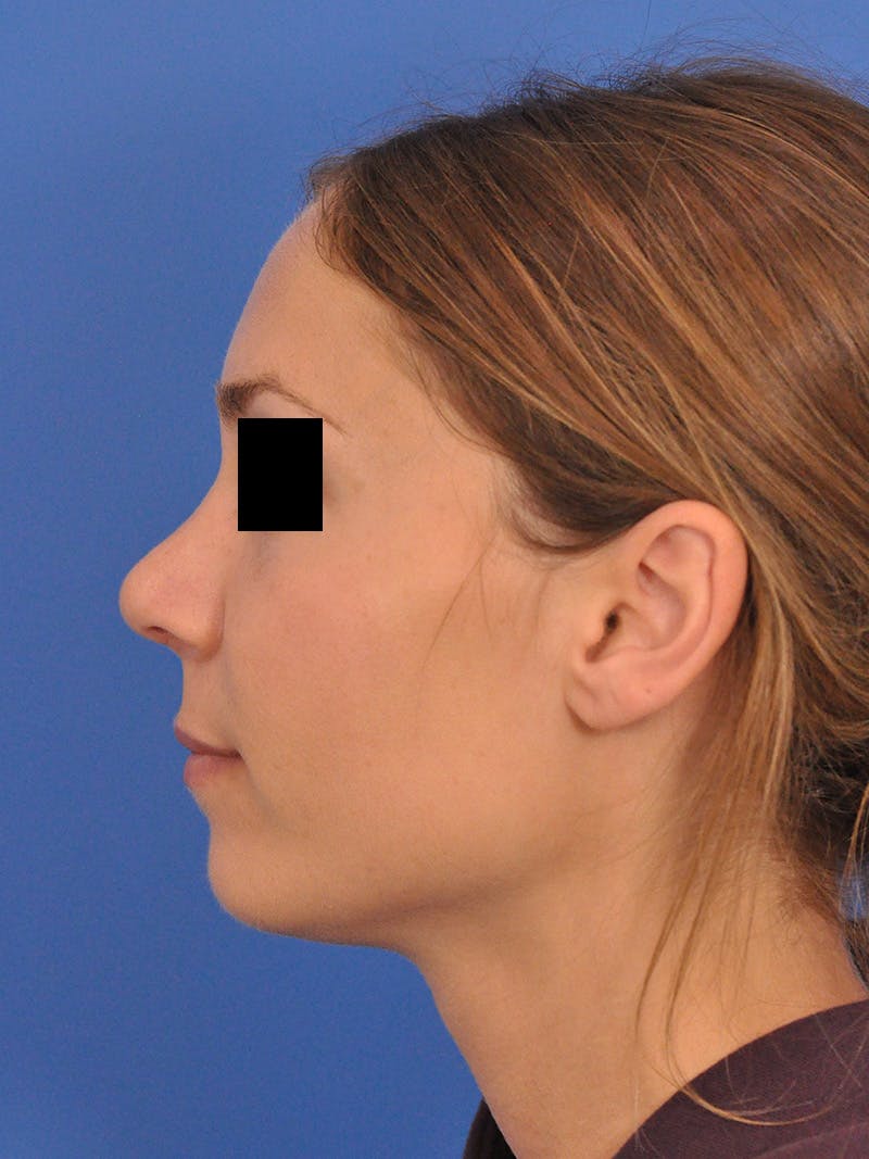 Rhinoplasty Before & After Gallery - Patient 230732 - Image 10