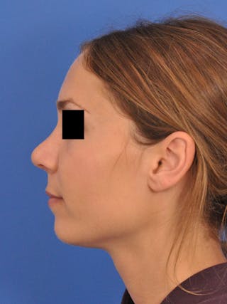 Rhinoplasty Before & After Gallery - Patient 230732 - Image 10