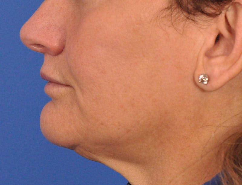 Lip Lift Before & After Gallery - Patient 271870 - Image 12