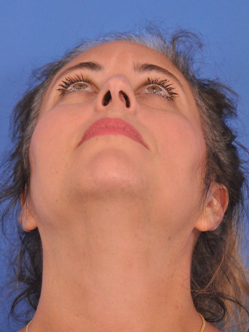 Rhinoplasty Before & After Gallery - Patient 347488 - Image 11