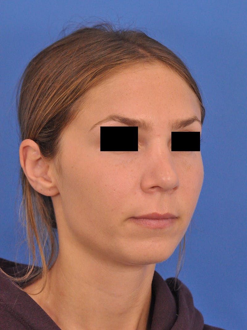 Rhinoplasty Before & After Gallery - Patient 230732 - Image 4