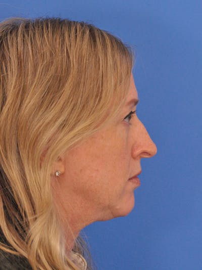 Rhinoplasty Before & After Gallery - Patient 315321 - Image 1