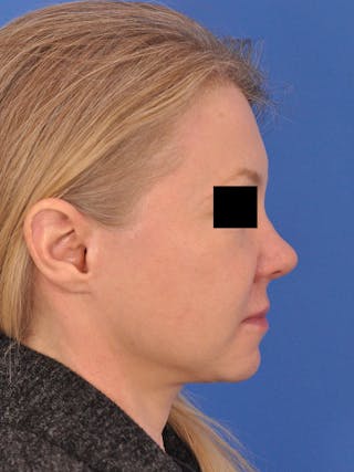 Facelift Before & After Gallery - Patient 202421 - Image 6
