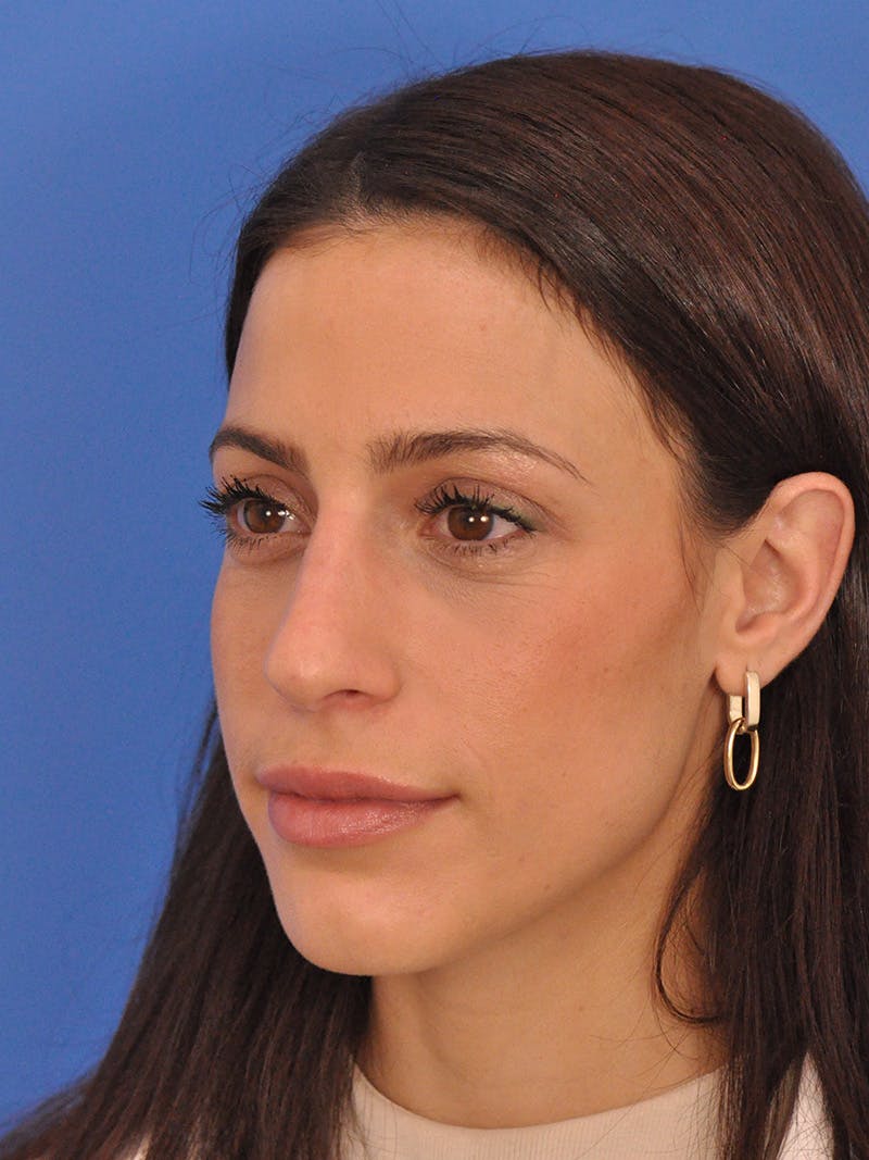 Rhinoplasty Before & After Gallery - Patient 100951 - Image 7