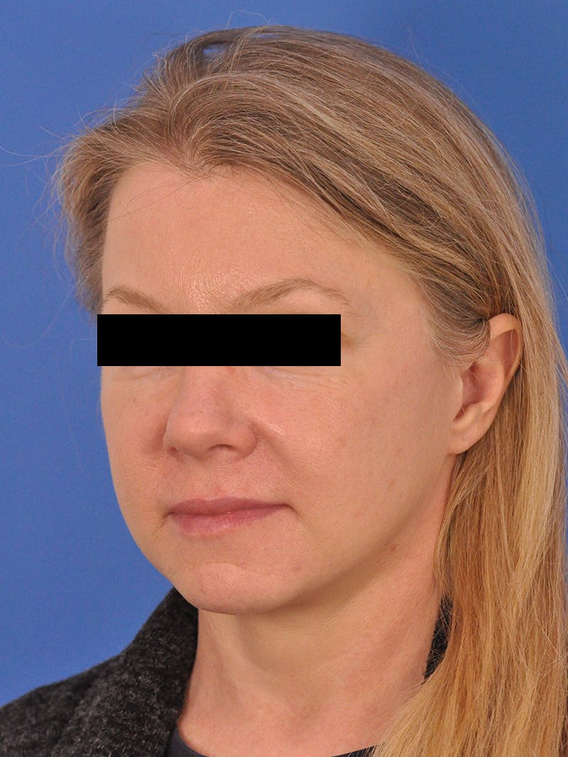 Facelift Before & After Gallery - Patient 202421 - Image 8