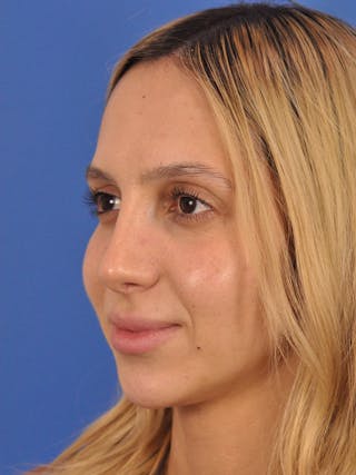 Rhinoplasty Before & After Gallery - Patient 587792 - Image 10