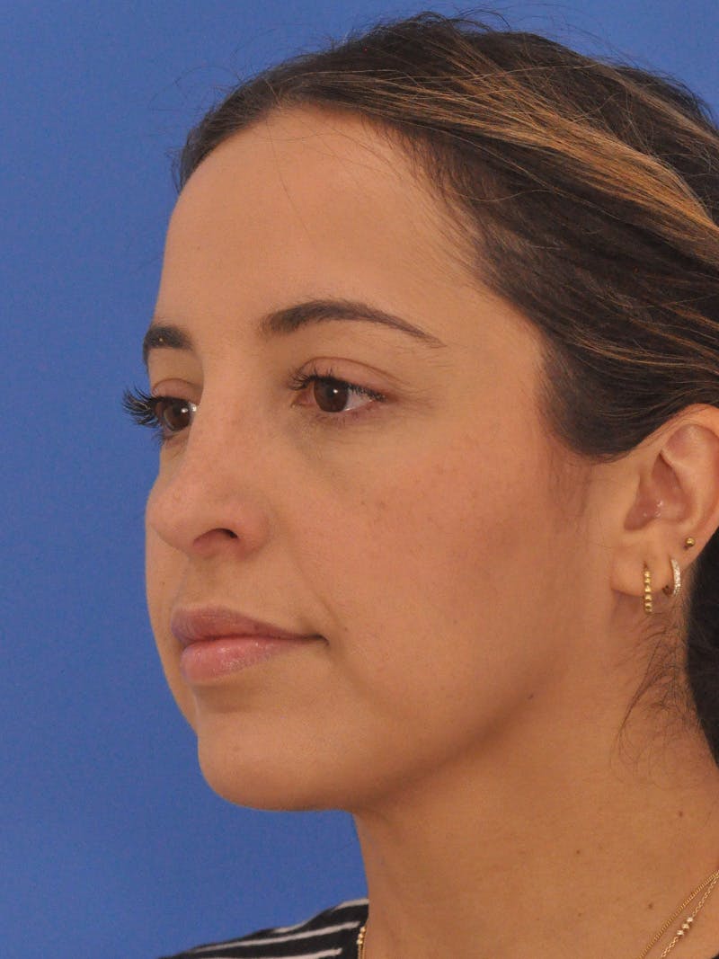 Rhinoplasty Before & After Gallery - Patient 277111 - Image 8
