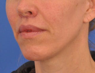 Lip Lift Before & After Gallery - Patient 336999 - Image 10