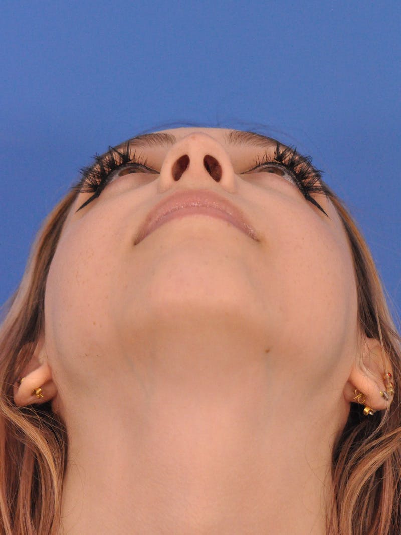 Rhinoplasty Before & After Gallery - Patient 192652 - Image 7