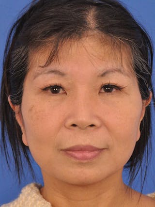 Facelift Before & After Gallery - Patient 227711 - Image 2