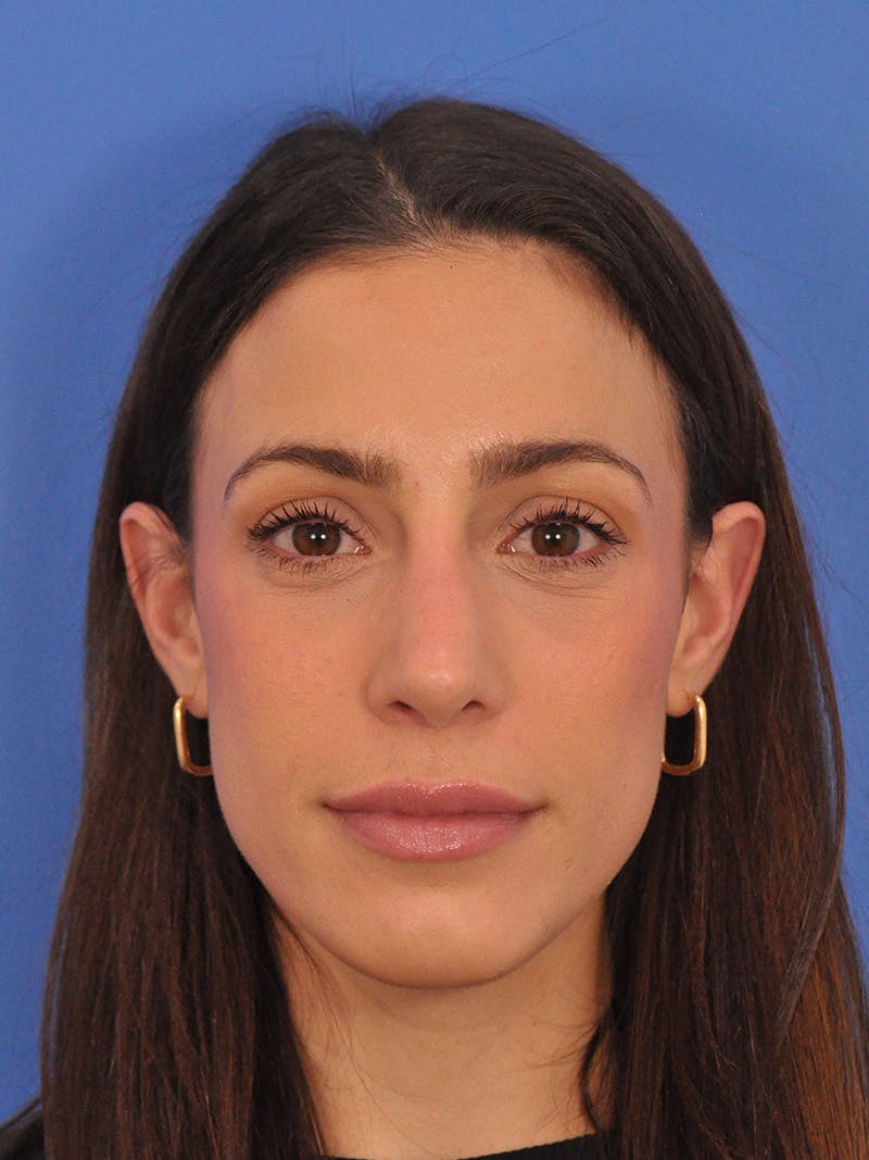 Rhinoplasty Before & After Gallery - Patient 100951 - Image 6