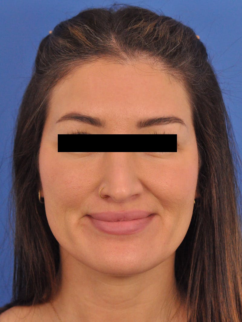 Brow Lift Before & After Gallery - Patient 233430 - Image 2
