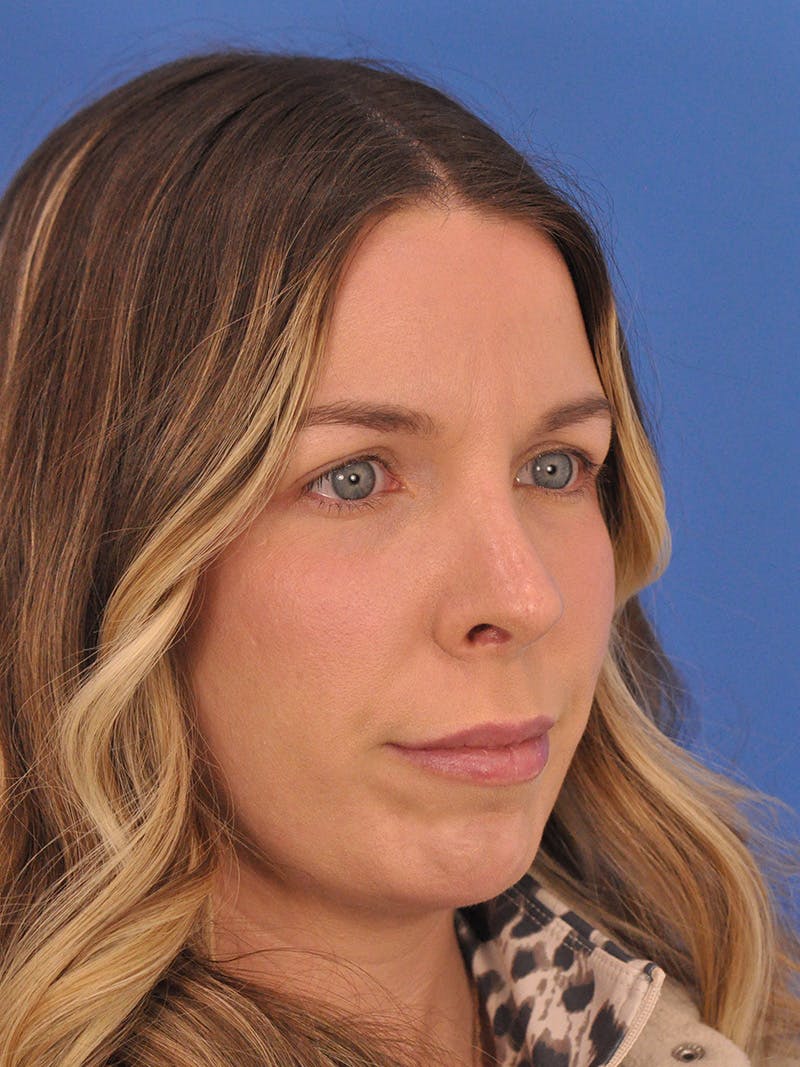 Rhinoplasty Before & After Gallery - Patient 135722 - Image 4