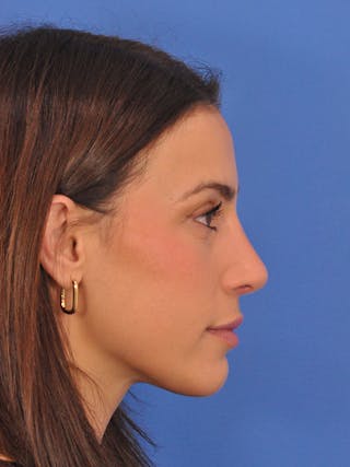 Rhinoplasty Before & After Gallery - Patient 100951 - Image 2