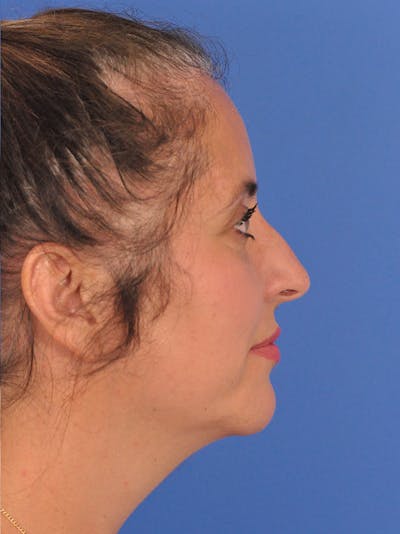 Rhinoplasty Before & After Gallery - Patient 347488 - Image 1
