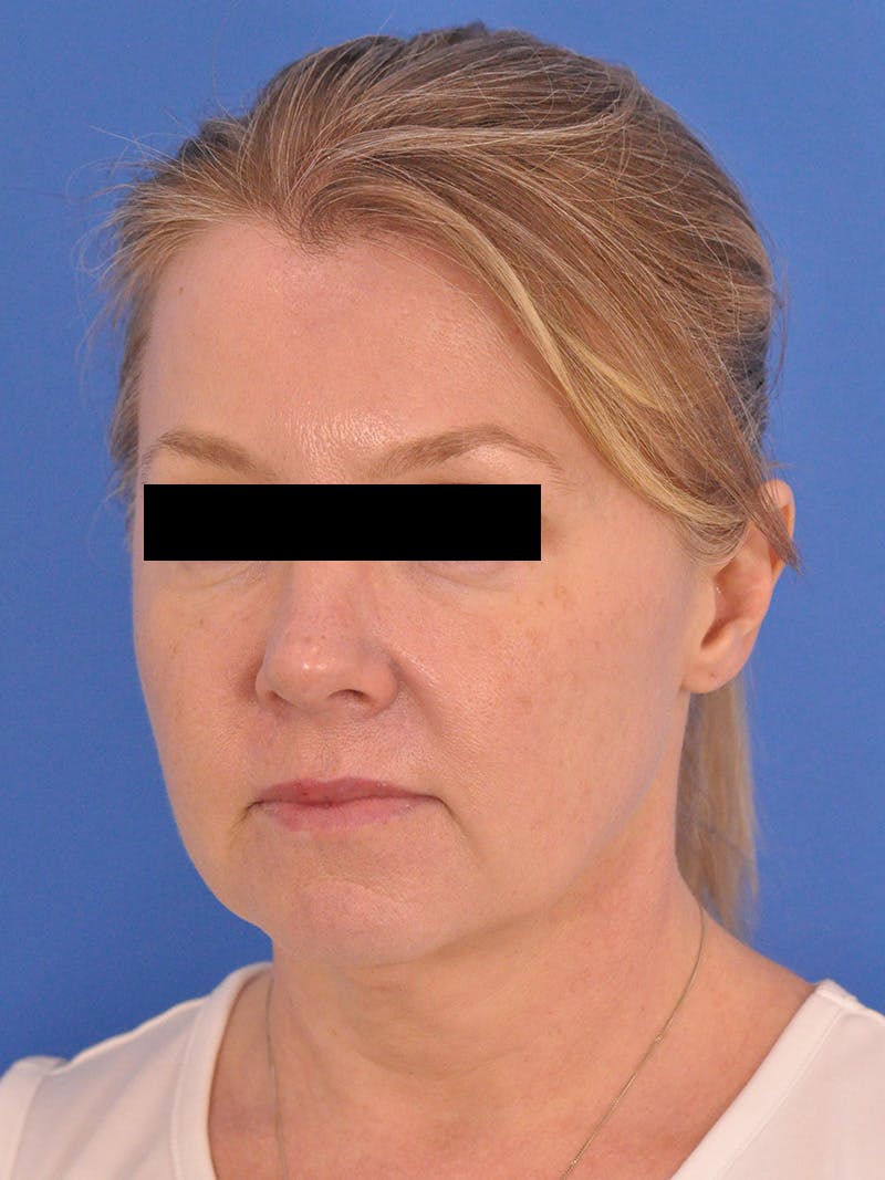 Facelift Before & After Gallery - Patient 202421 - Image 7