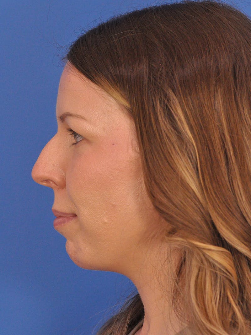 Rhinoplasty Before & After Gallery - Patient 135722 - Image 9