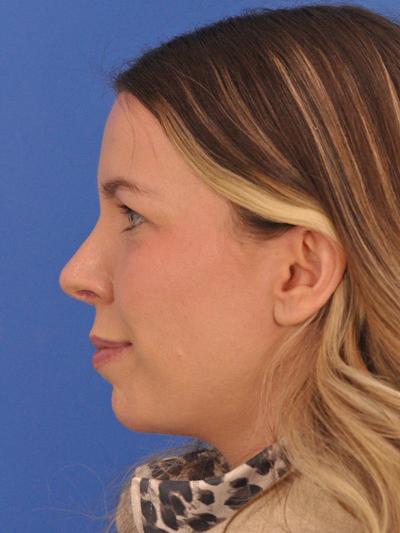 Rhinoplasty Before & After Gallery - Patient 135722 - Image 10