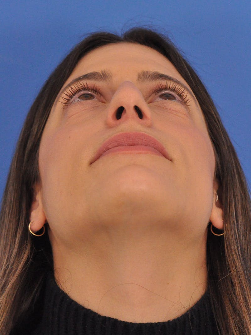 Rhinoplasty Before & After Gallery - Patient 574327 - Image 11