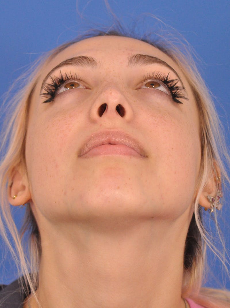 Rhinoplasty Before & After Gallery - Patient 192652 - Image 8
