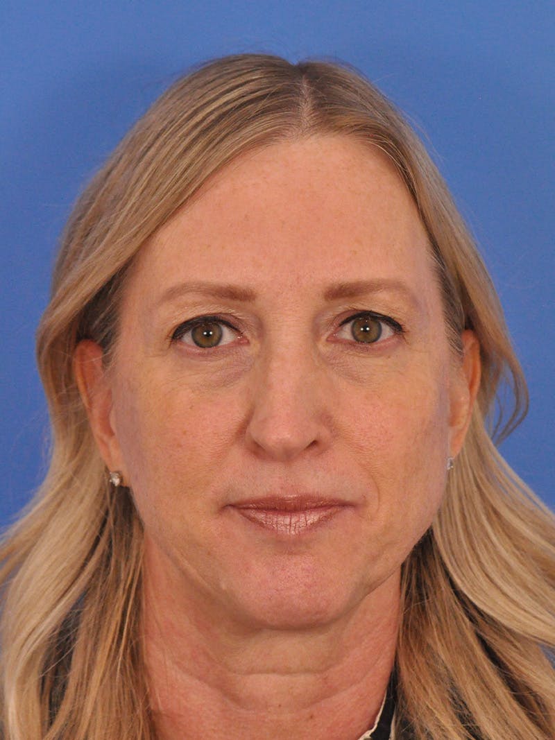 Rhinoplasty Before & After Gallery - Patient 315321 - Image 5