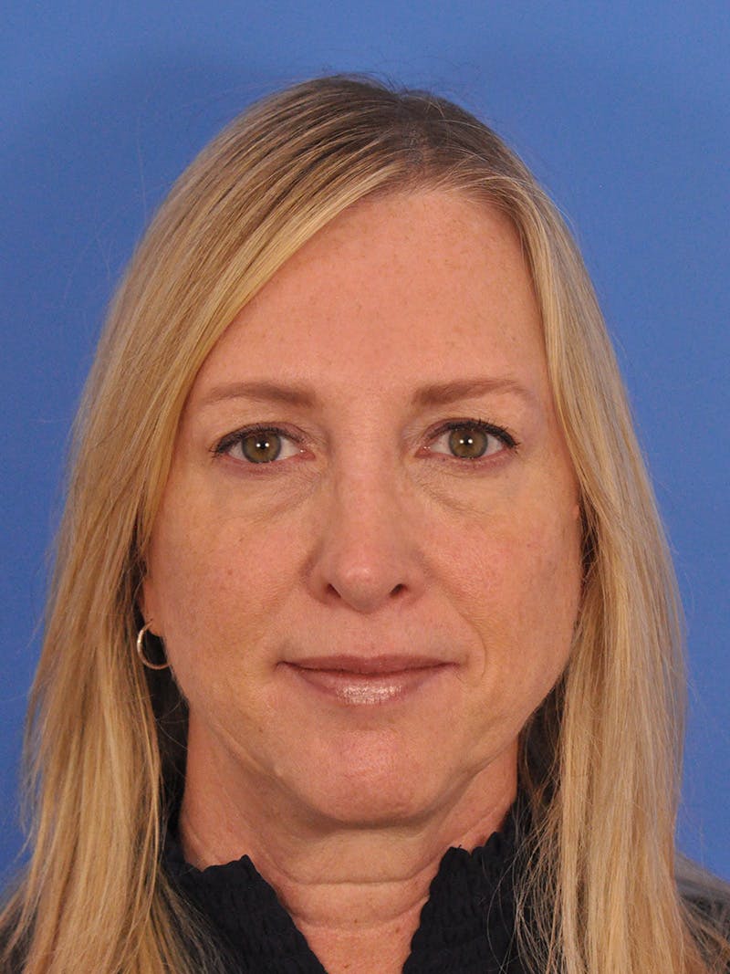 Rhinoplasty Before & After Gallery - Patient 315321 - Image 6