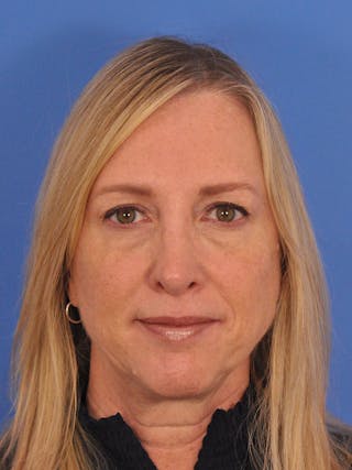 Rhinoplasty Before & After Gallery - Patient 315321 - Image 6