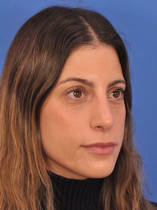 Rhinoplasty Before & After Gallery - Patient 574327 - Image 4