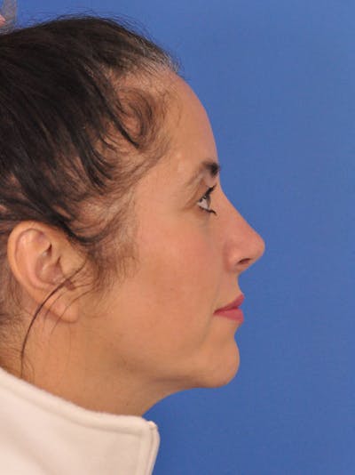 Rhinoplasty Before & After Gallery - Patient 347488 - Image 2